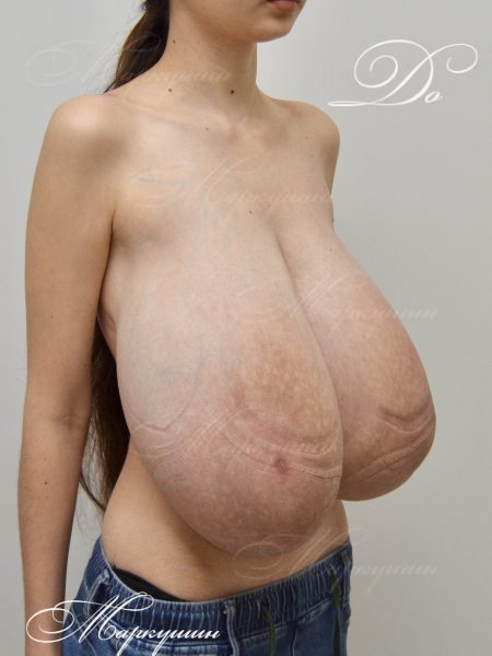 Some More Huge Titties Before Reduction #4sHfiIJ6