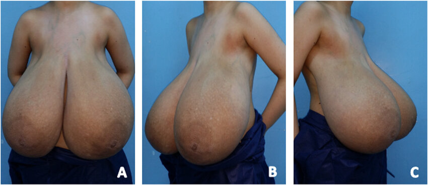 Some More Huge Titties Before Reduction #9LWa733T