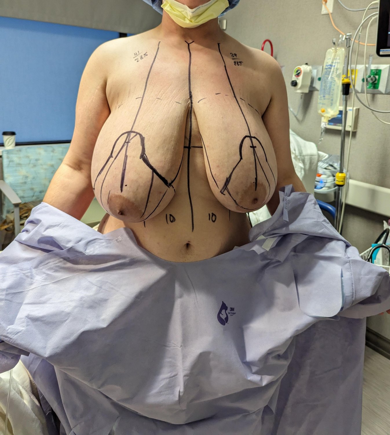 Some More Huge Titties Before Reduction #fv8x4tBl