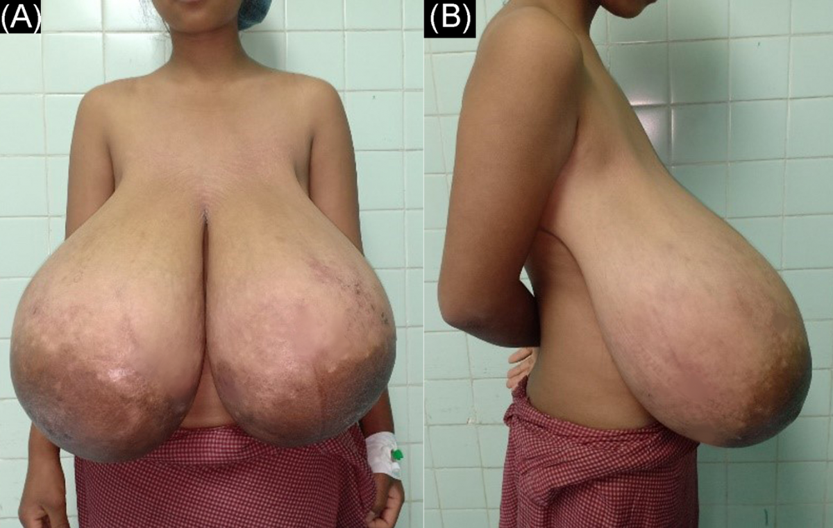 Some More Huge Titties Before Reduction #fWx8TdFu