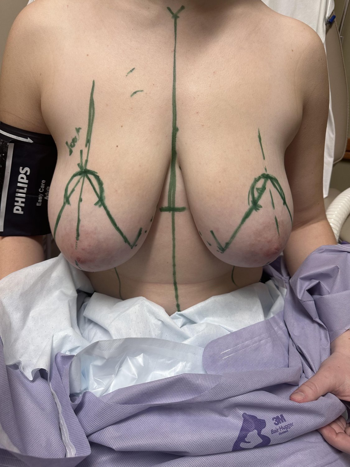 Some More Huge Titties Before Reduction #Ik3zG7lt