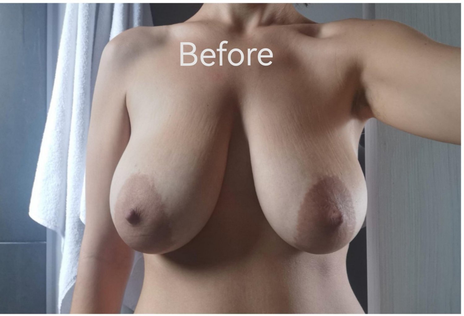 Even More Huge Titties Before Reduction #jvSCHWgO