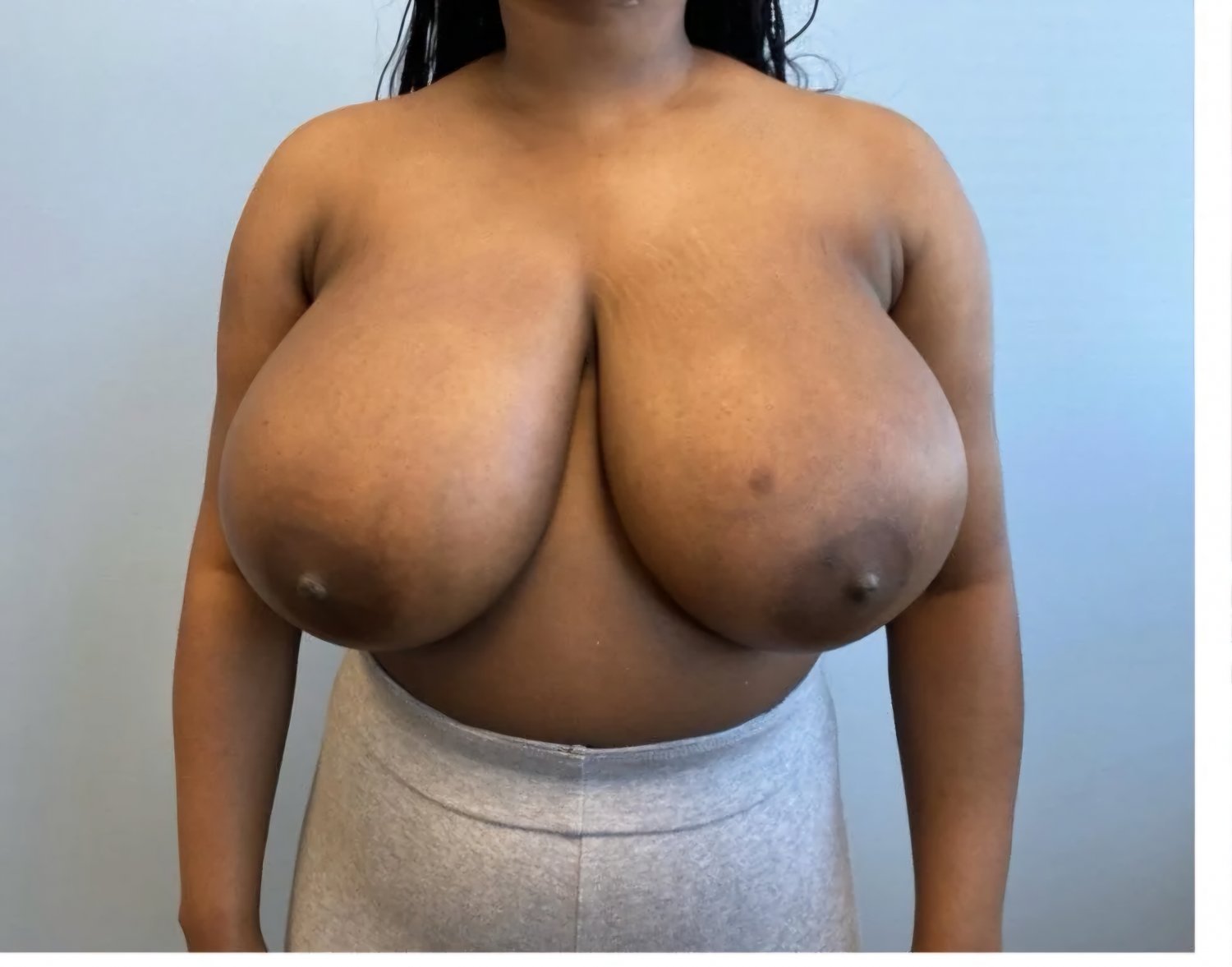 Even More Huge Titties Before Reduction #T8ILLIWM