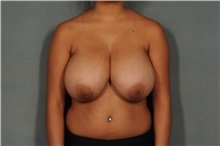 Some More Huge Titties Before Reduction #VOxjP7Ll