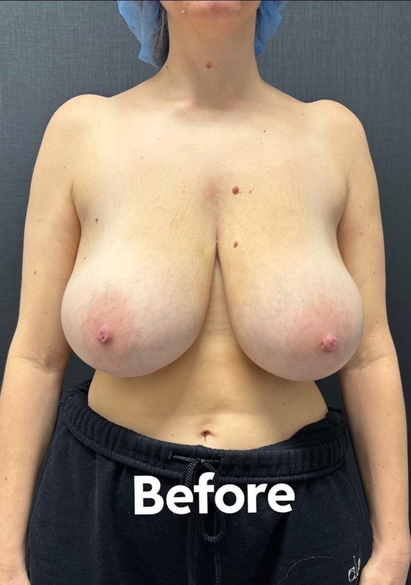 Big Tits Before Reduction 6 #4AIUOIp9