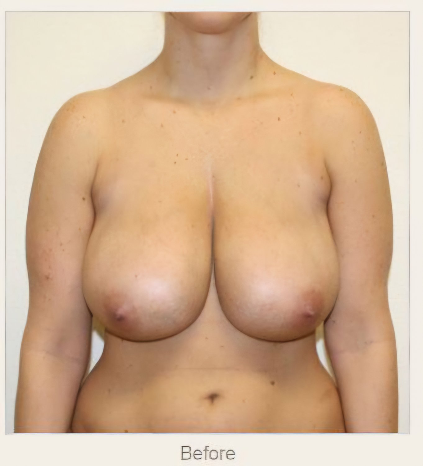 Big Tits Before Reduction 6 #7DsCHPO3