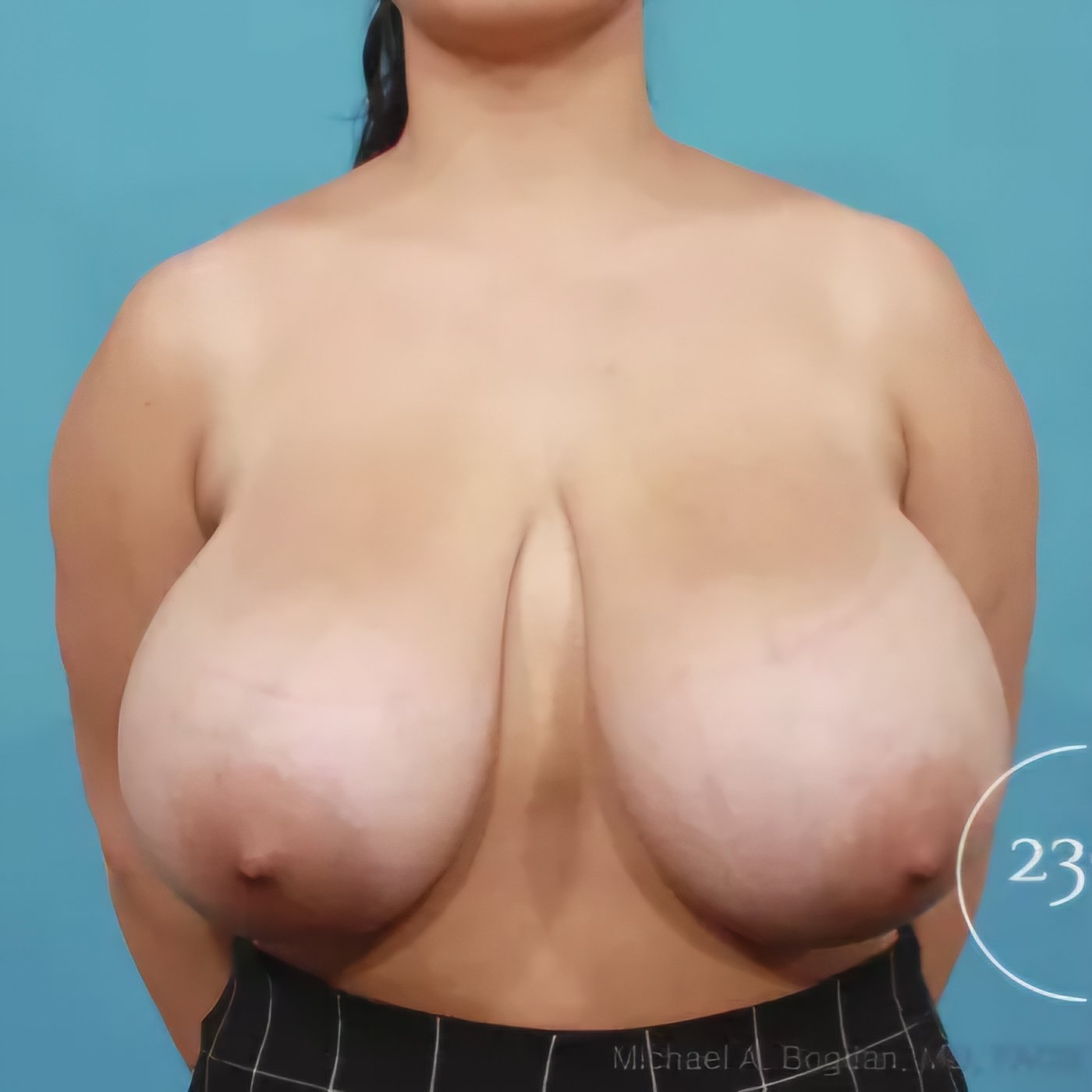 Big Tits Before Reduction 6 #KSl7qqxO